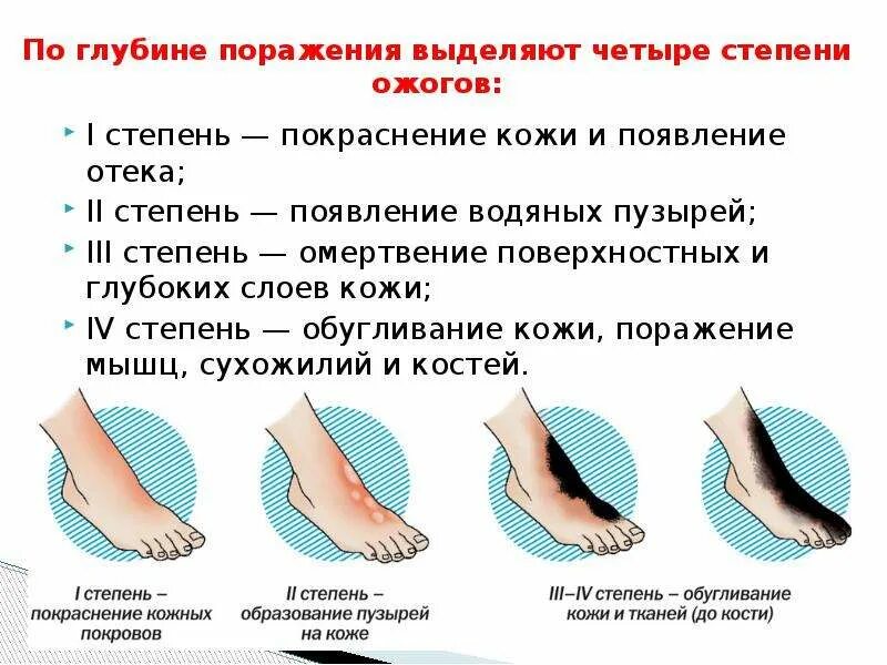 Характерный симптом термического ожога 2 степени. Термический ожог 1 степень 2 степень 3 степень 4 степень первая помощь. Ожог 1 степени и 2 степени. 1 Степень ожога 2 степень поражения.