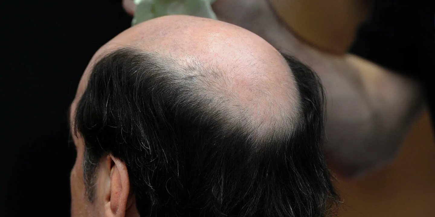 Male Pattern Baldness Hereditary - FREE PATTERNS