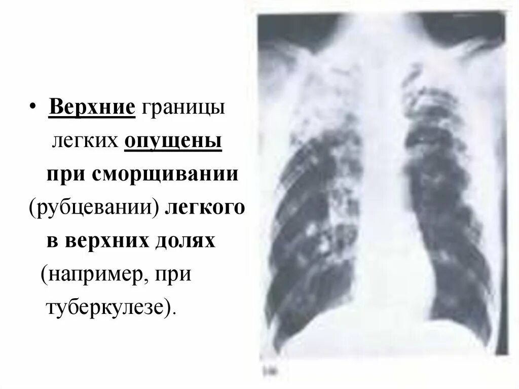Базальный пневмосклероз на рентгене. Паракостальный фиброз это. Рубцы от пневмонии на рентгене. Рубцевание легкого. Рубцевание легкого.