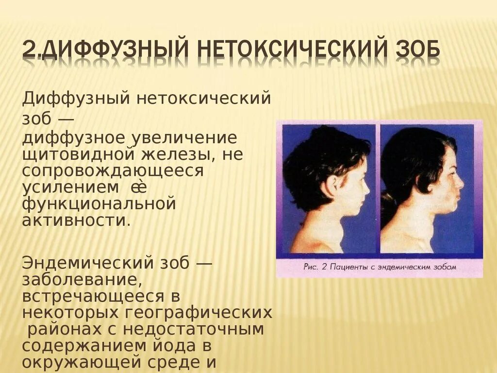 Нетоксический зоб щитовидной. Диффузно-Узловой нетоксический зоб. Нетоксический многоузловой зо.. Диффузно Узловой зоб степени.