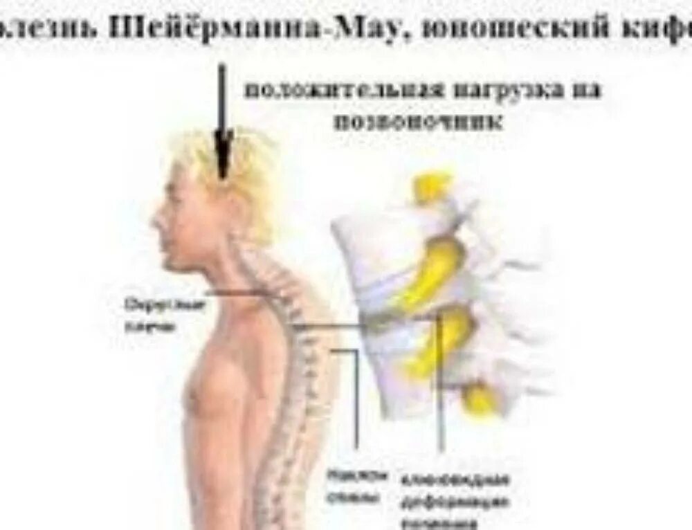Болезнь шейермана мау что это такое. - Гиперкифоз (болезнь Шейермана-МАУ). Болезнь Шейермана МАУ грудного отдела. Кифоз грудного отдела болезнь Шейермана МАУ. Болезнь позвоночника Шейермана-МАУ У подростков.