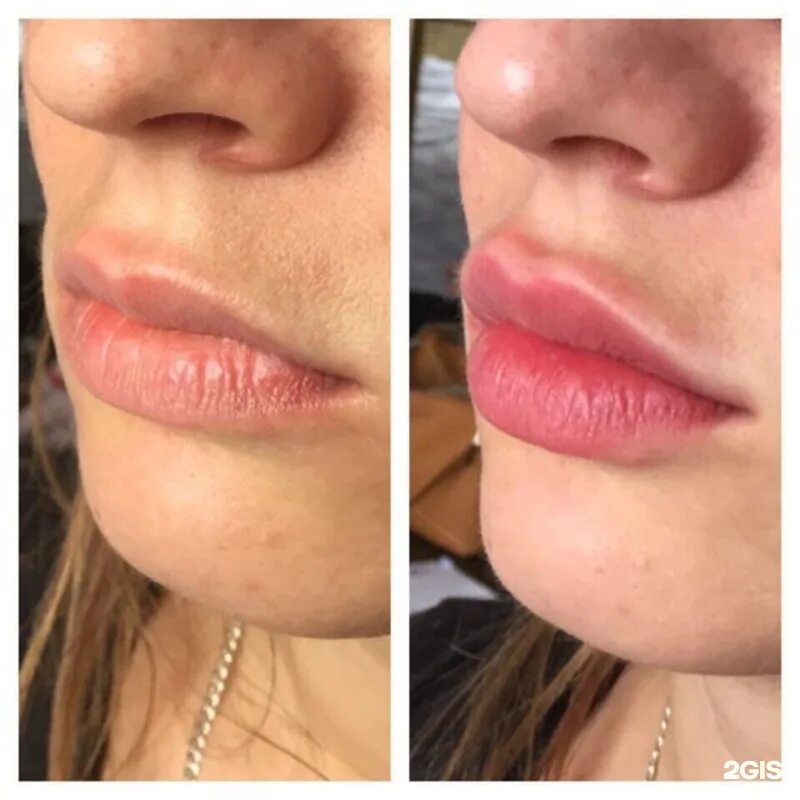 Накаченные губы до и после. Красивые накаченные губы до и после. Гиалуроновая кислота в губы 1 мл. Накаченные губы до и после. Накаченные губы до и после.
