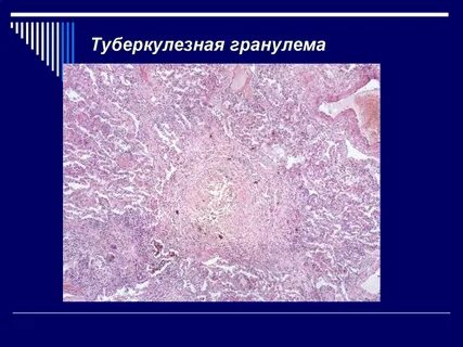 Гранулема туберкулеза