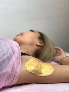 Полимерная депиляция