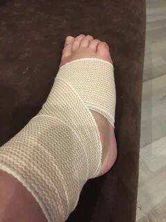 Гипс при растяжении связок голеностопного