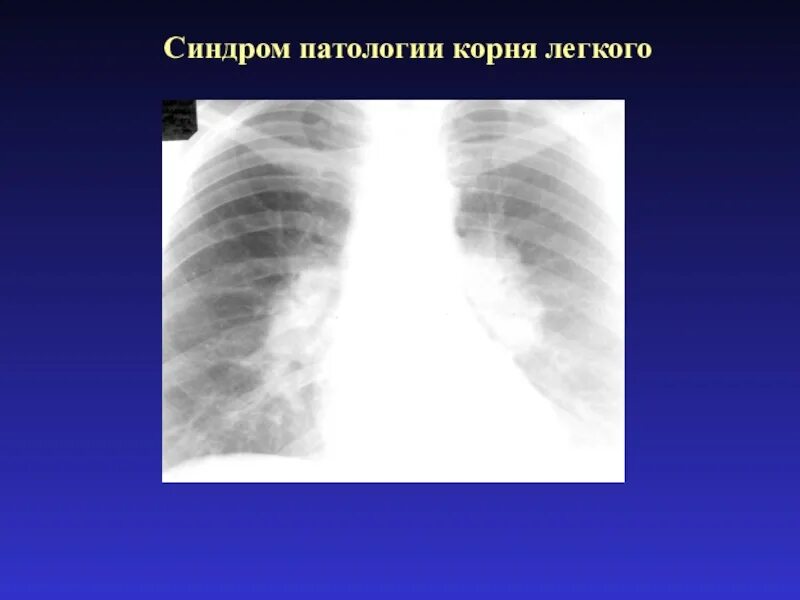 Патология корня легкого. Синдром патологии корня легкого. Синдром полициклические измененного корня легкого. Синдром патологических изменений корня легкого.