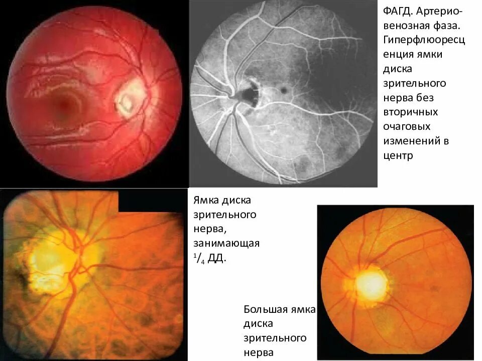 Атрофия зрительного нерва у детей. Врождённые заболевания диска зрительного нерва. Ямка диска зрительного нерва.