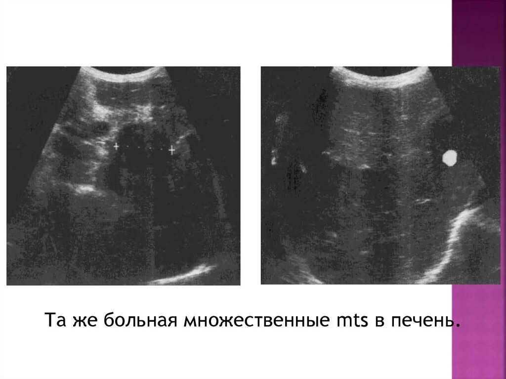 Как выглядят метастазы печени на узи. Метастазы в печени по узи. множественные метастазы в печени. узи при метастазах печени.