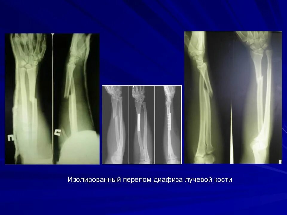Лучевая трещина. Перелом диафиза лучевой кости. Перелом дистального метаэпифиза лучевой кости. Локтевая кость перелом диафиза. Перелом эпифиза метаэпифиза лучевой кости.