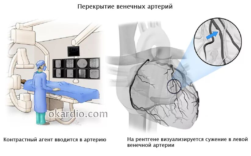 Рентгеноконтрастная коронарография. Коронароангиография подготовка. Подготовка пациента на коронографию.