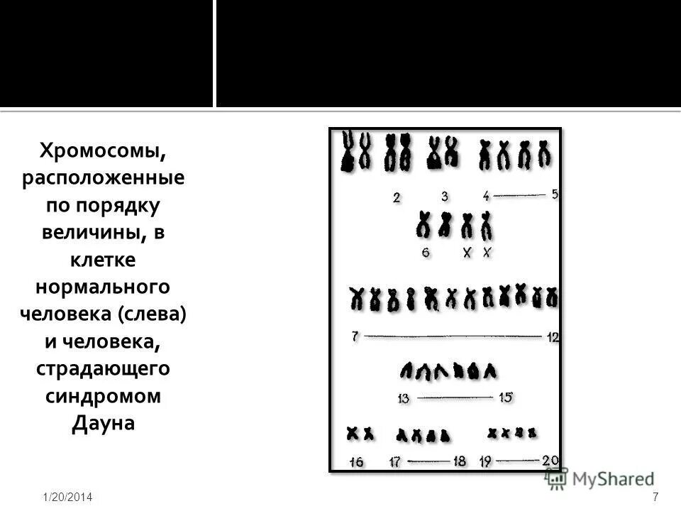 трисомия по 21 хромосоме. сколько хромосом у дауна и нормального человека. сколько хромосом у дауна и нормального человека. синдром дауна (трисомия по 21 паре хромосом). болезнь дауна набор хромосом.