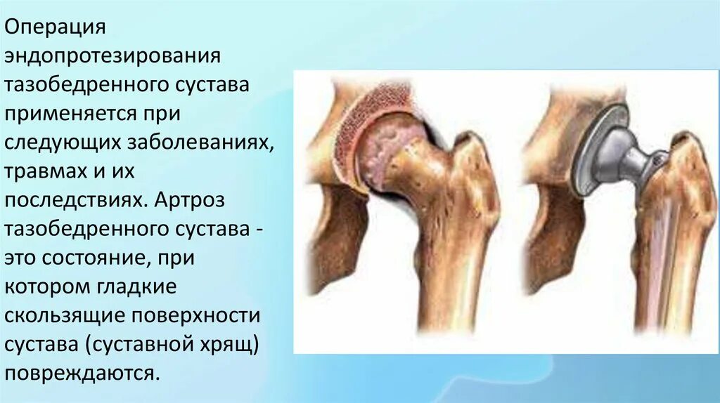 Какие болезни тазобедренного сустава. Артрит коксартроз тазобедренного. заболевание тазобедренного сустава коксартроз. артроз тазобедренного сустава эндопротез. артроз корешковый тазобедренного сустава.