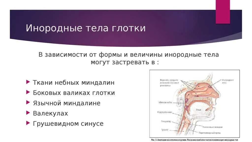 Ощущение инородного тела при глотании. Попадание инородных тел в ротовую полость признаки нарушения. классификация инородных тел глотки. народные тела в глотке.