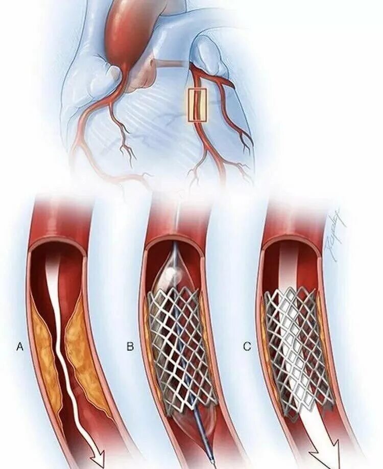 Вставили стент. Стентирование коронарных артерий. Коронарное стентирование сосудов сердца. Шунтирование сосудов сердца стент.