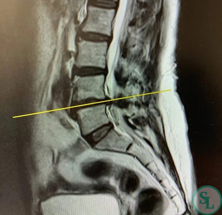 Протрузии межпозвонковых дисков l4 s1. Межпозвонковые диски l4/l5 l5/s1. Грыжа /экструзия диска l4-l5 l5 l4. Межпозвонковые диски l3-l4. Грыжа l3-l4.