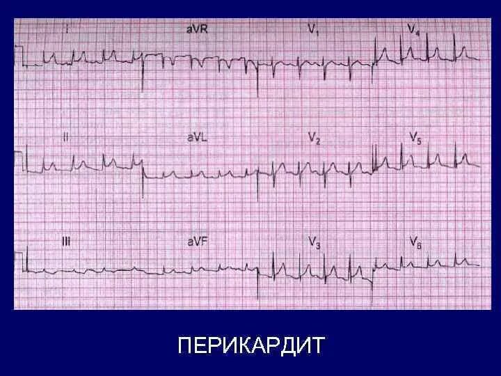 Эгк. Перикардит экг диагностика. номер эгк. эгк фото.