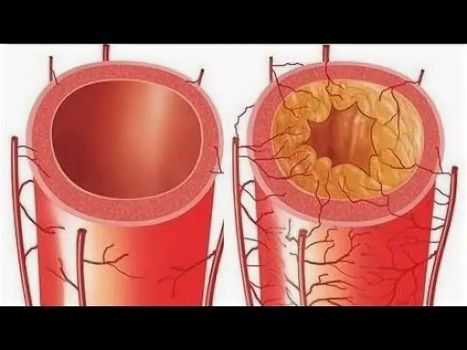 Как чистить сосуды сердца. Как чистить сосуды сердца