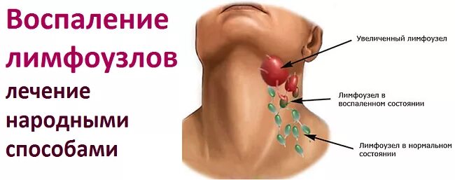 Шейный лимфоузел воспаление. Воспалённые лимфатические узлы на шее чем лечить. Лимфоузлы причина лечения в домашних