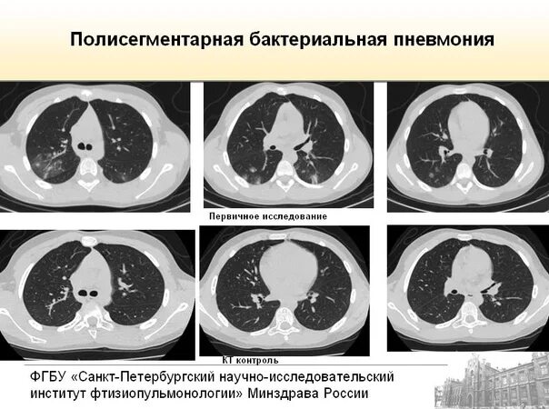 Двусторонняя сегментарная