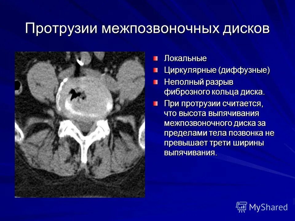 Диффузное выбухание межпозвоночного. Протрузии дисков позвоночника кт. Циркулярная протрузия диска на кт. Протрузия межпозвонкового диска кт. Диффузное выбухание диска.