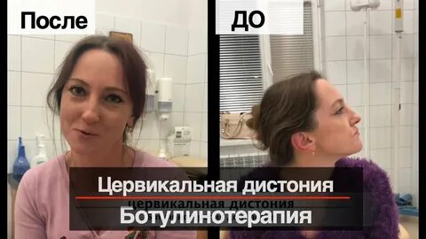 Болит голова после ботокса