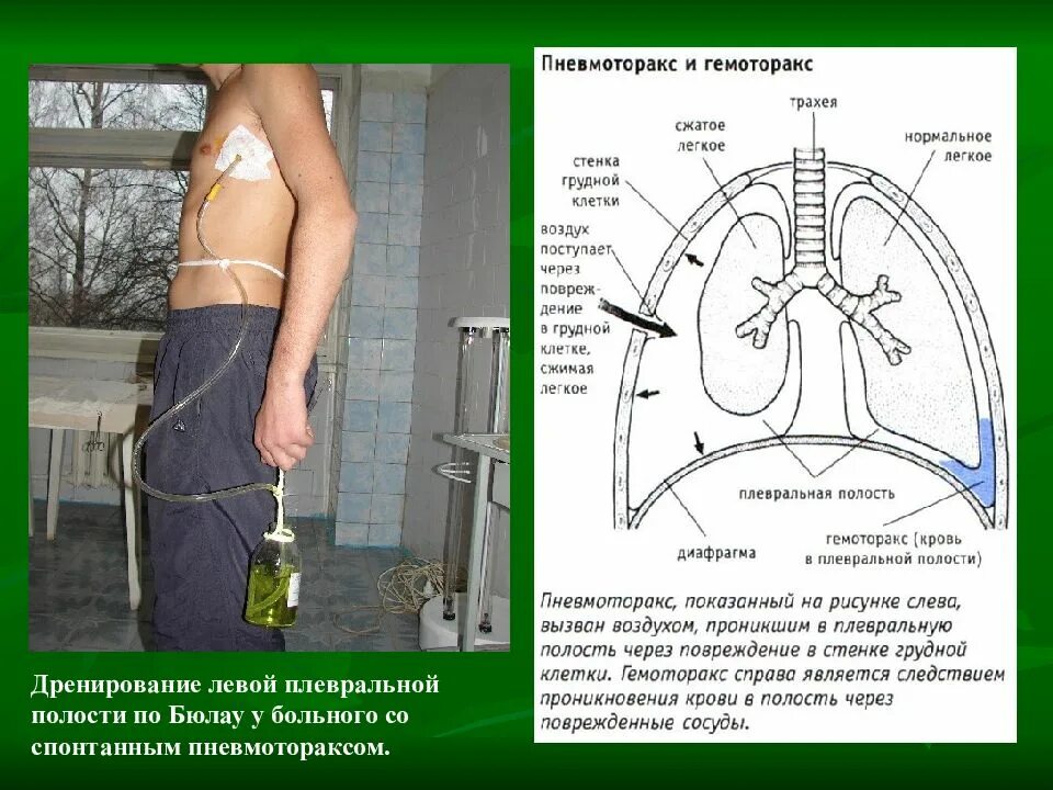 Плевральная пункция гидроторакс. Дренирование плевральной полости. Дренирование пневмоторакса. Дренирование при пневмотораксе.