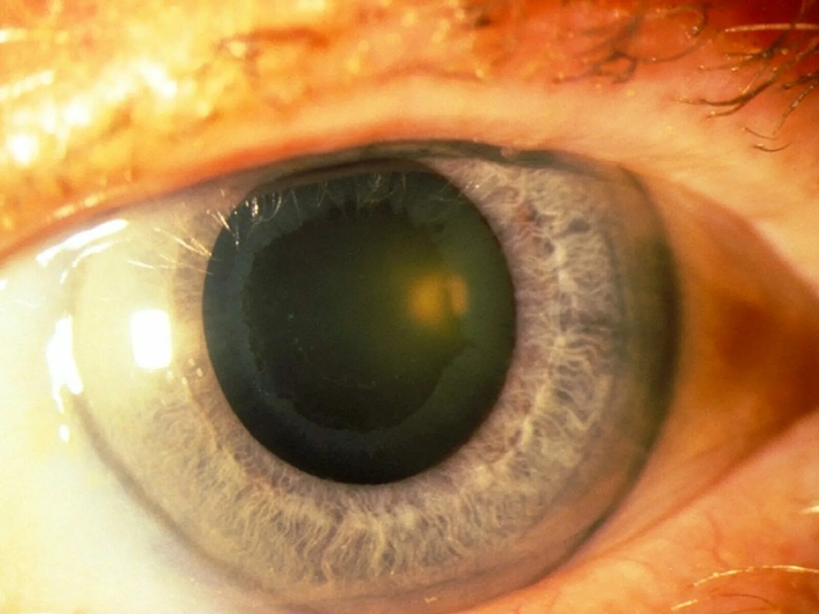 Куриная слепота 2. Закрытоугольная глаукома глаза. Постувеальная глаукома. Гиперсекреторная глаукома.
