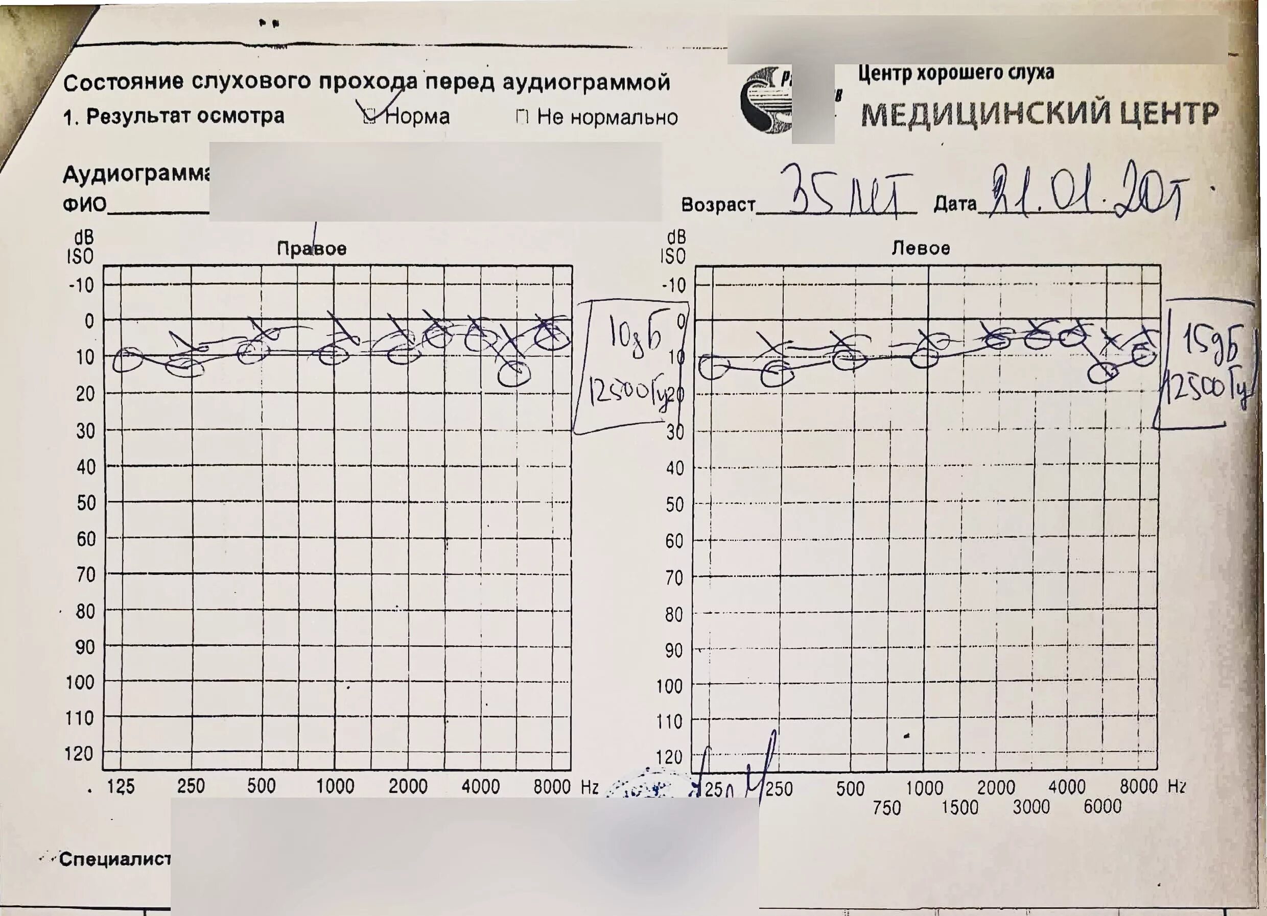 Аудиограмма норма. Аудиограмма слух -10дб. Аудиограмма норма заключение. Аудиограмма слуха норма график. Аудиограмма 1 степени тугоухости.