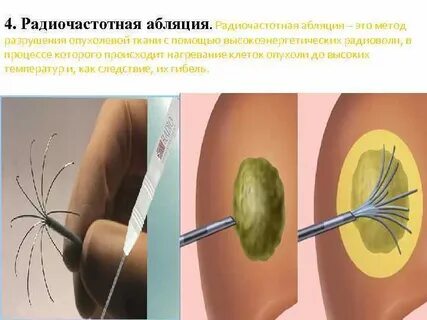 Абляция