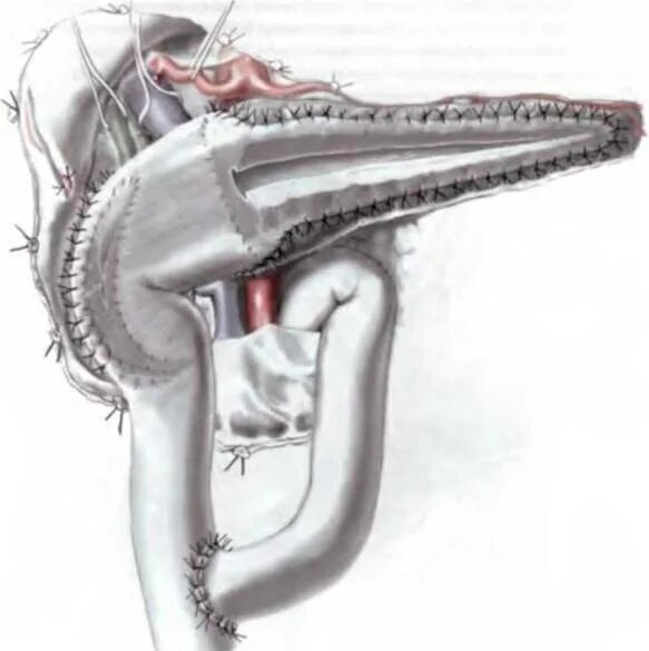 Поджелудочная железа панкреатит операция. Операция Бегера на поджелудочной железе. Корпорокаудальная резекция поджелудочной железы. Резекция поджелудочной железы Фрея.