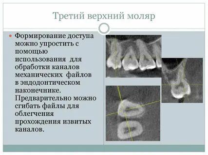 Третий моляр верхней