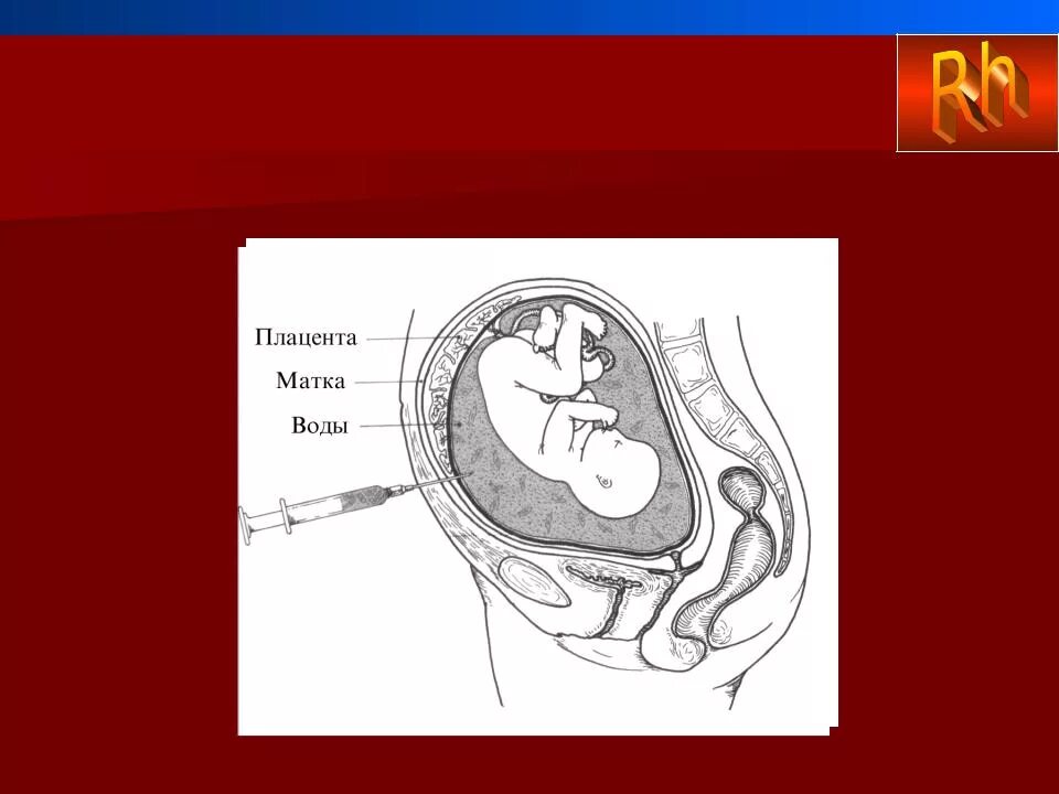 Ребенок в плаценте матке. Плацента матка пуповина.