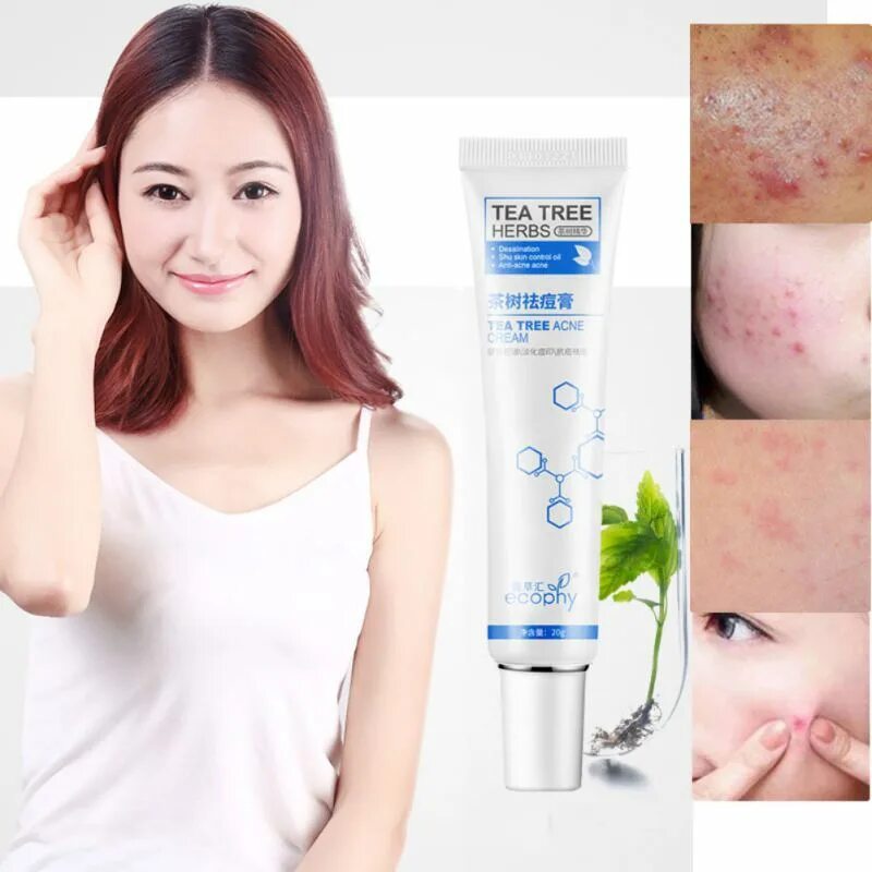 акне беременных. акне беременных. разновидность угревой сыпи. алгоритм лечения акне. акне беременных.