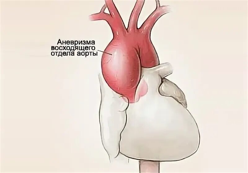 Аневризма восходящей аорты операция. Аневризматическое расширение восходящего отдела аорты на кт. Аневризма восходящего отдела аорты 47мм. Мкб расширение восходящего отдела аорты.