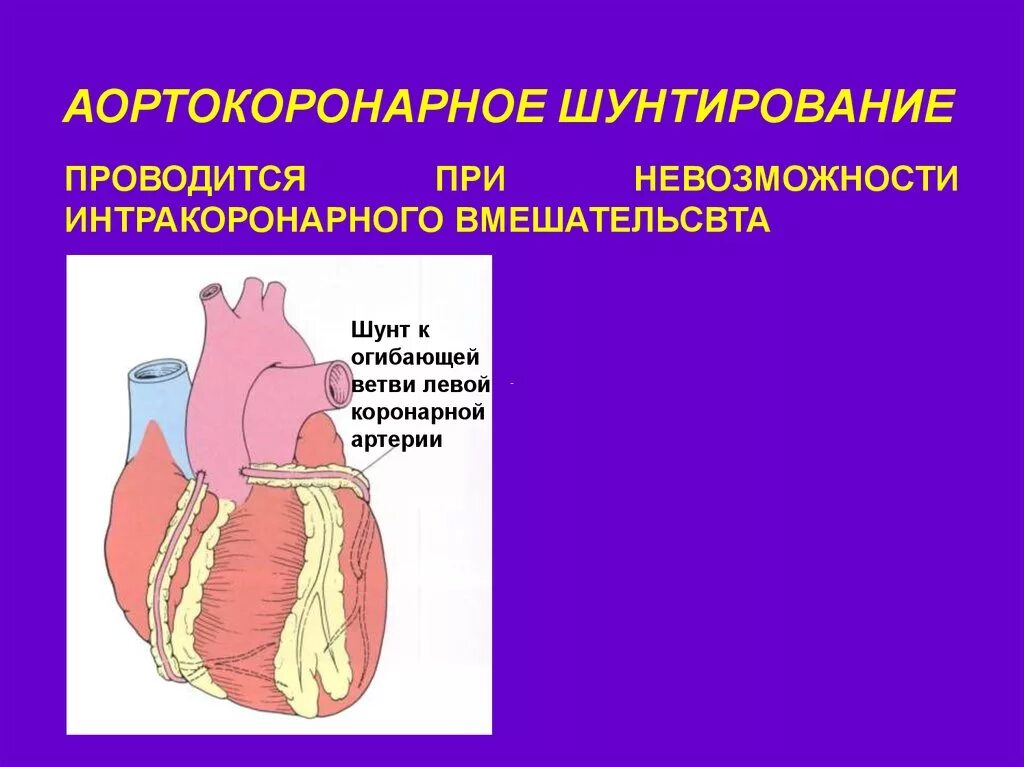 Схема операции аортокоронарного шунтирования. Аортокоронарное шунтирование при ИБС. Аорта коронарное шунтирование. Аорто копонарное шунтирование. Как делают коронарное шунтирование