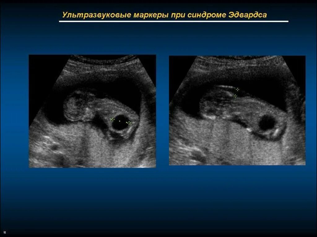 Синдром Патау на УЗИ 1 скрининг. Ультразвуковые маркеры. Ультразвуковые маркеры хромосомных аномалий плода.