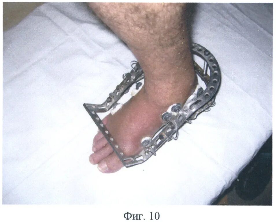 Компрессионно-дистракционный остеосинтез аппаратом илизарова. Внешняя фиксация при переломах. Спицевой аппарат внешней фиксации. Внеочаговый остеосинтез аппаратом илизарова. Внешняя фиксация при переломах.