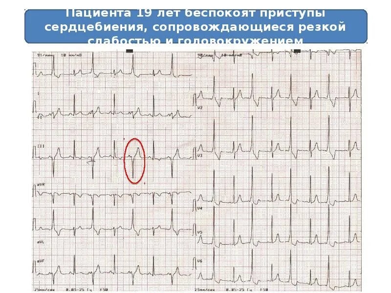 Элевация сегмента st. Элевация сегмента st на экг v2 v3. элевация ст на экг. элевация сегмента st на экг. элевация сегмента st на экг причины.