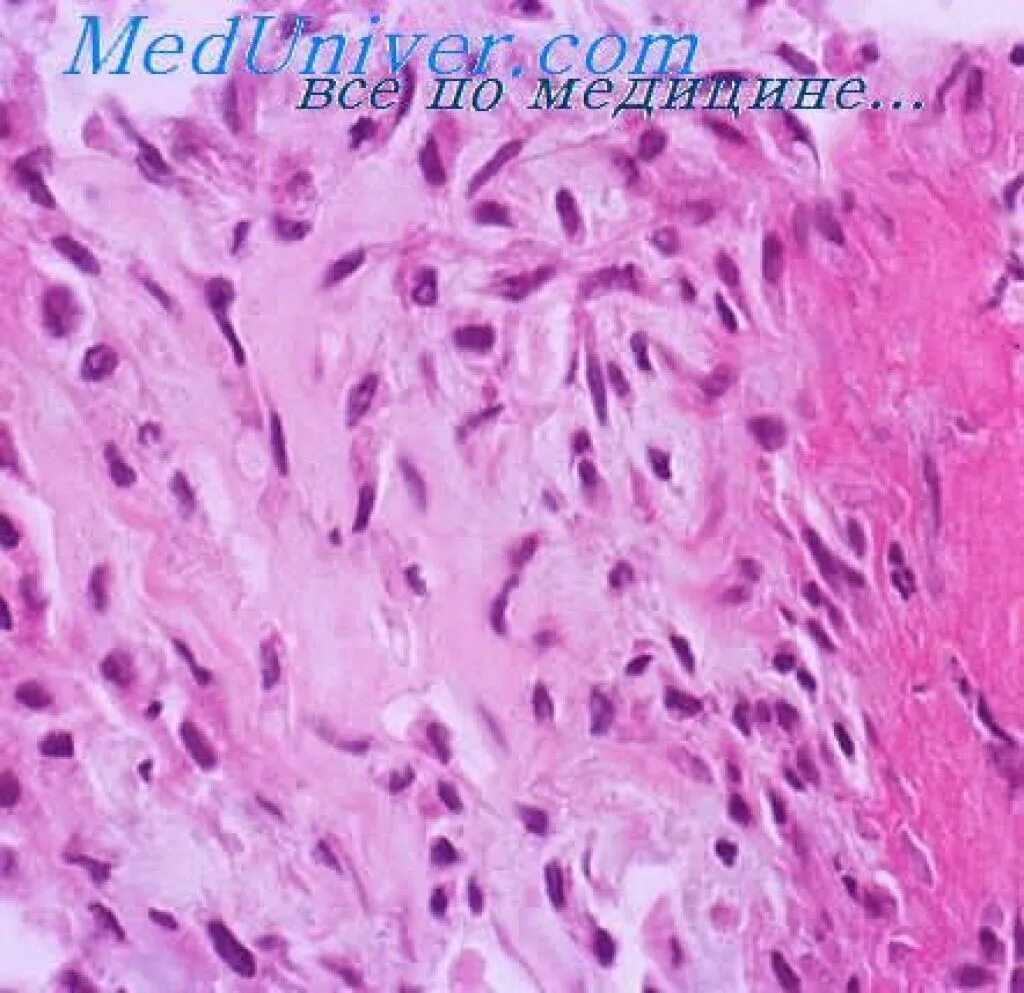 Опухоль абрикосова гистология. Опухоль абрикосова. Опухоли мезенхимальной ткани патанатомия. Опухоль абрикосова гистология. Зернистоклеточная опухоль абрикосова гистология.