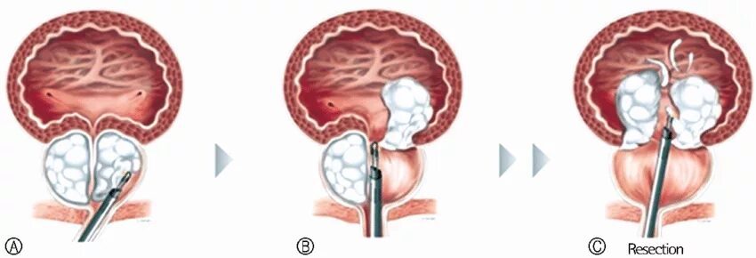 Биполярная трансуретральная резекция простаты. Лазерная энуклеация предстательной железы. Энуклеация аденомы простаты. Гиперплазия предстательной железы операция