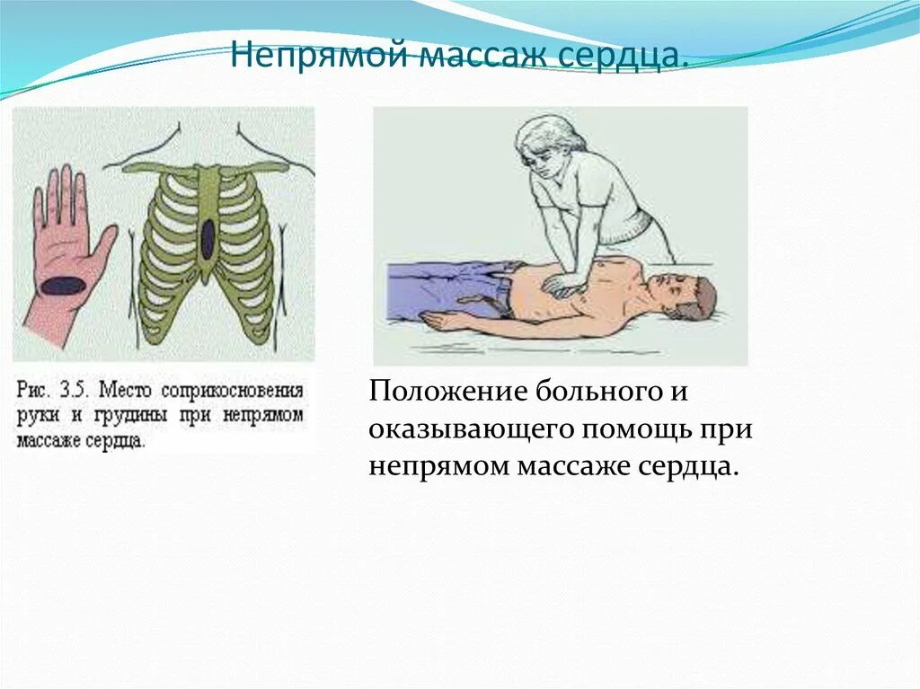 Непрямой массаж сердца скорость