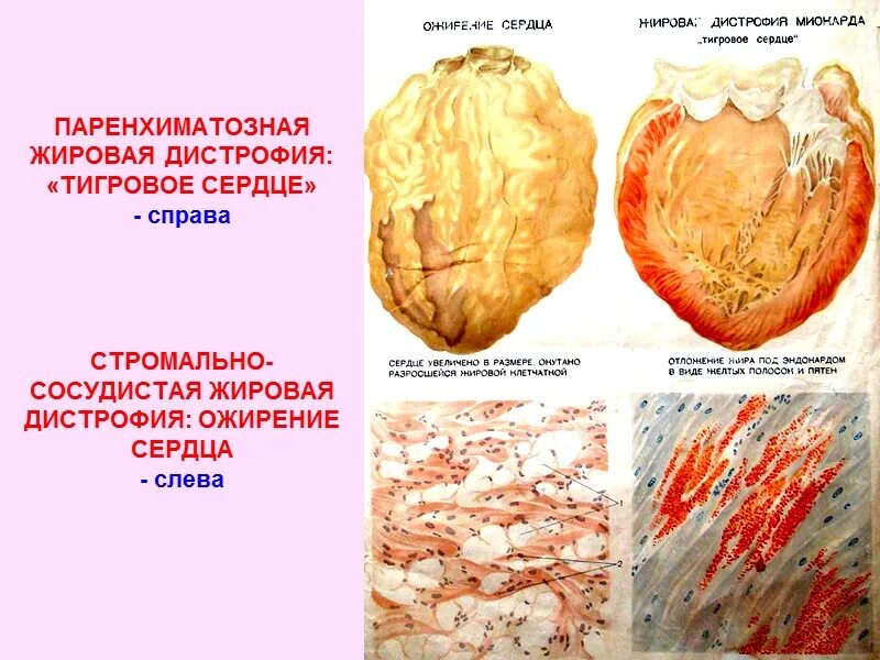 Жировая инфильтрация миокарда. Тигровое сердце патологическая анатомия. Жировая дистрофия сердца. Жировая дистрофия миокарда Тигровое сердце.