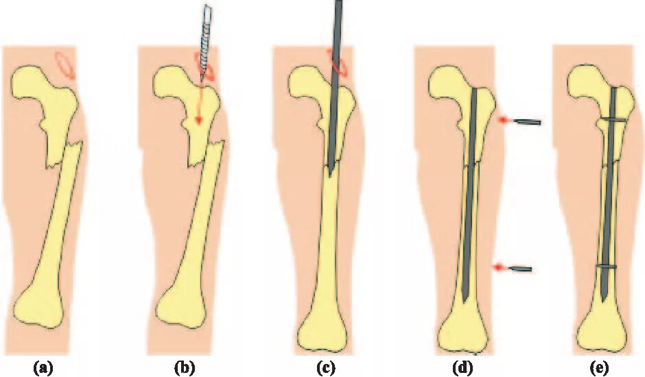 Температура после перелома. Внутрикостный остеосинтез. Интрамедуллярный (внутрикостный) остеосинтез. Внутрикостный остеосинтез диафиза бедренной кости. Остеосинтез бедренной кости операция.