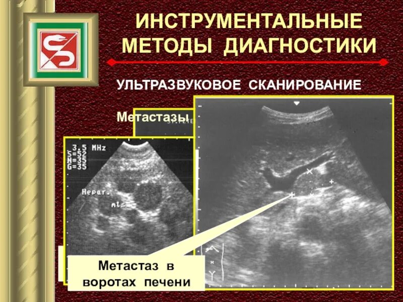 Метастазы в печени прогноз срока. Метастатические опухоли печени. печень пораженная метастазами. метастазы в воротах печени. метастазы в печени печени.