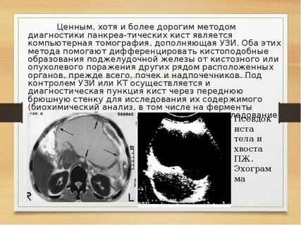 Поджелудочная железа кистозно солидное образование