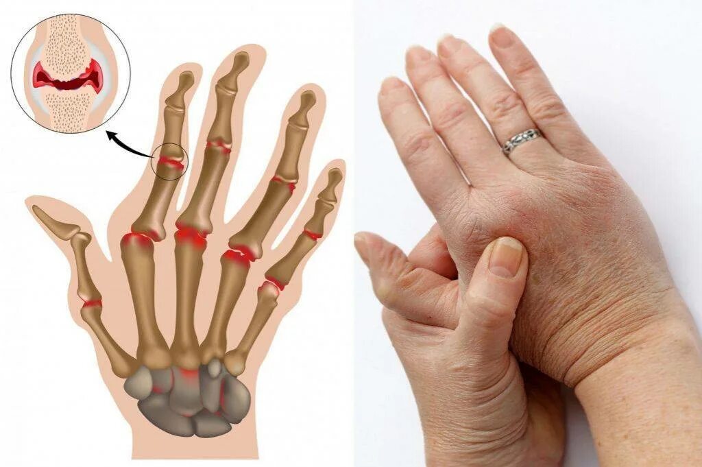 Ревматоидный артрит кисти. Ревматоидный артрит лучезапястного сустава. Фаланга ревматоидный артрит. Анкилоз суставов пальцев.