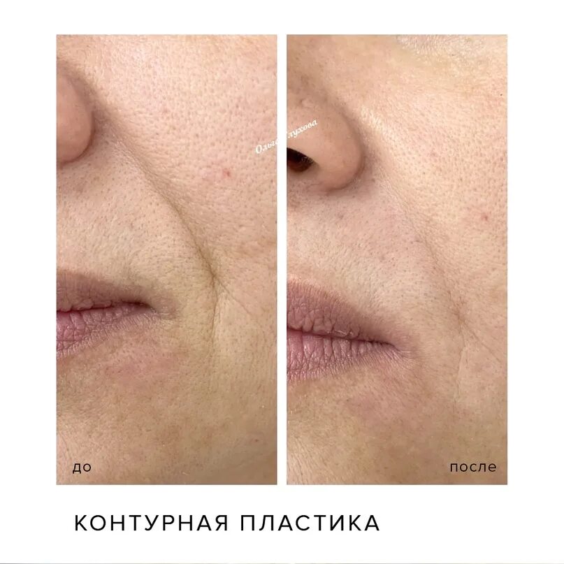 Коррекция носогубных складок Цены в Москве Age Clinic