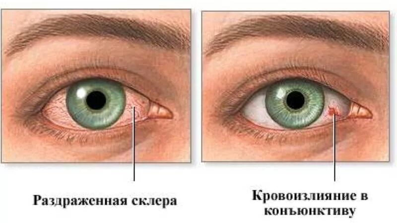Глаза при диабете 2 типа