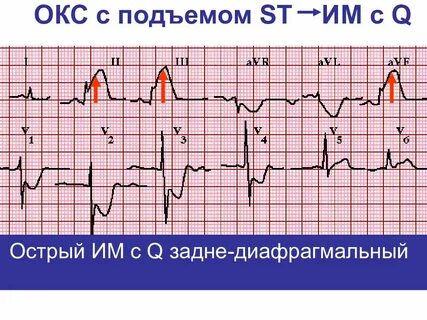 Инфаркт без st