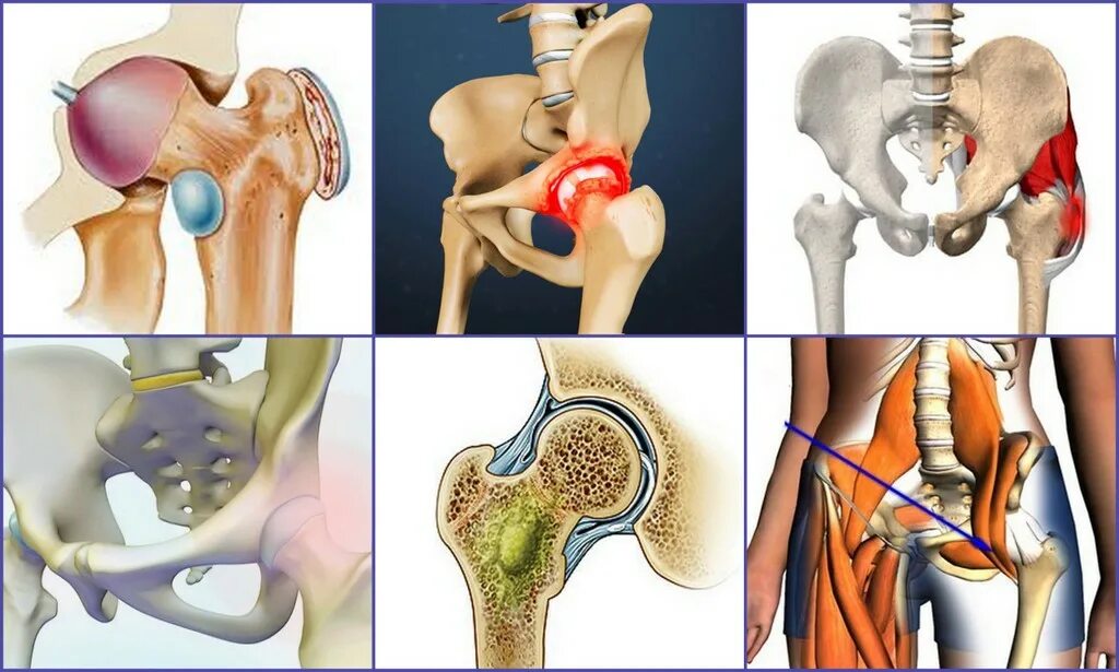 ТБС тазобедренного сустава. Коксалгия тазобедренного сустава. Оссифицирующий бурсит тазобедренного сустава. Трохантерит тазобедренного сустава симптомы. Болит бедро операция